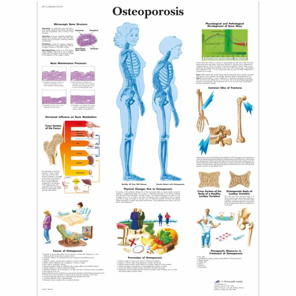AK VR1121  OSTEOPOROZA