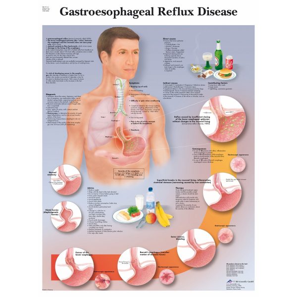 AK VR1711  GASTRO OBOLJENJA